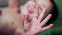 La OMS advirtió sobre el crecimiento de los casos de sarampión en el mundo