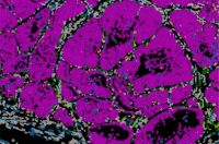 Hallan un gen que determina si las células de cáncer formarán metástasis o se quedarán dormidas