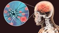 Aumentaron los casos de meningitis por encima de lo esperado y piden reforzar la vacunación