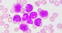 9 de cada 10 pacientes con leucemia linfocítica crónica no reconocen los síntomas antes del diagnóstico