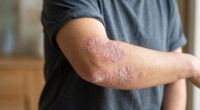 Día Mundial de la Psoriasis: tener poca piel afectada no siempre significa una enfermedad leve
